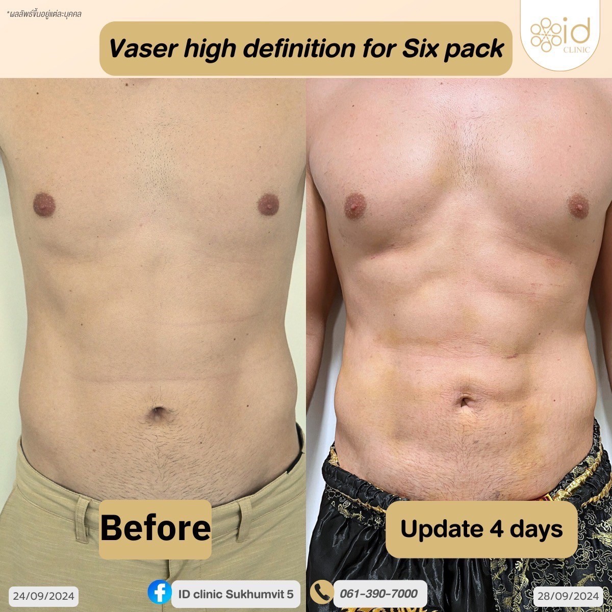 Vaser Hi-Def Liposuction for Six pack